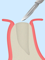STEP 01　歯茎の切開