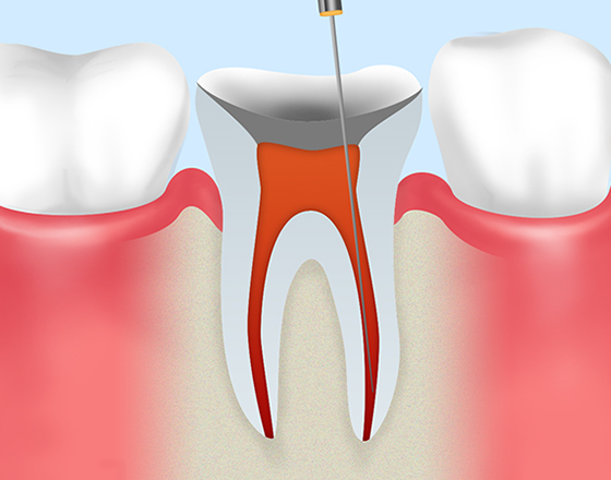 重度の虫歯は根から治します